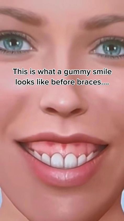 margaretiuochristopherau16 Gummy Smile Aesthetic, Gummy Teeth, Invisible Teeth Braces, Braces Ideas, Braces Smile, Dental Cement, Braces Off, Dental Braces, Gummy Smile