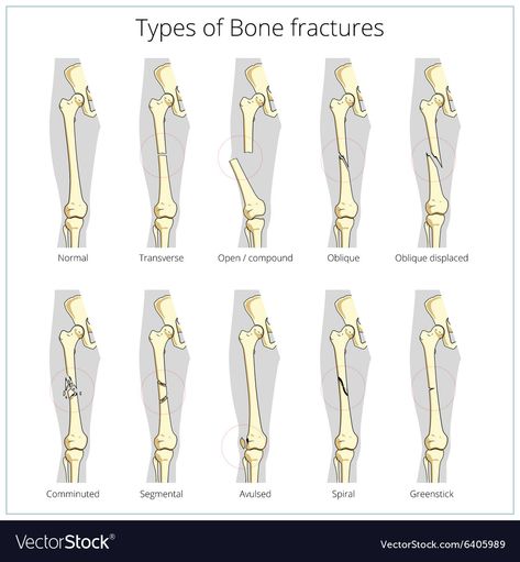 Medical Skeleton, Stitches Medical, Human Anatomy Organs, Types Of Fractures, Anatomy Organs, Types Of Bones, Radiology Technician, Skeleton Anatomy, Bone Fracture