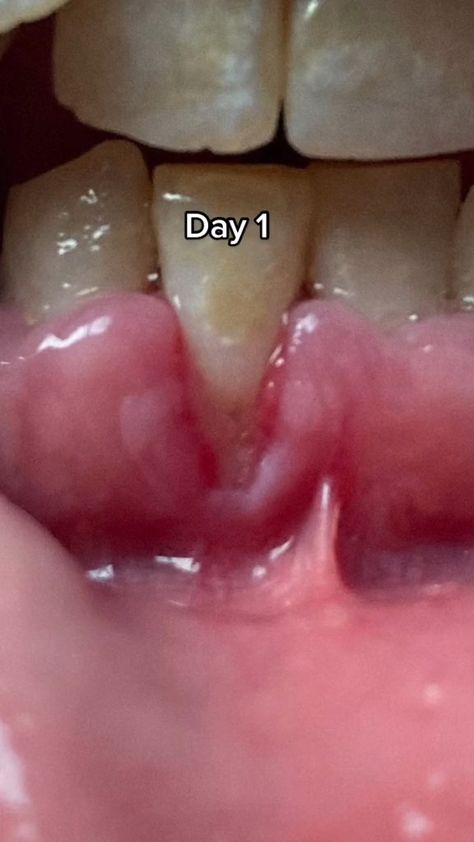 Grow Back Receding Gums, Fix Teeth, Oral Care Routine, Gum Care, Receding Gums, Oral Health Care, Tooth Decay, Oral Hygiene, Dental Health