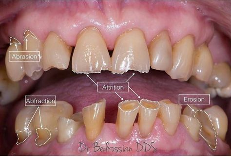 Dental Assistant Study, Dental Hygiene Student, Dental Decay, Dental Videos, Kedokteran Gigi, Dental Hygiene School, Dentistry Student, Dental Anatomy, Dental Fun