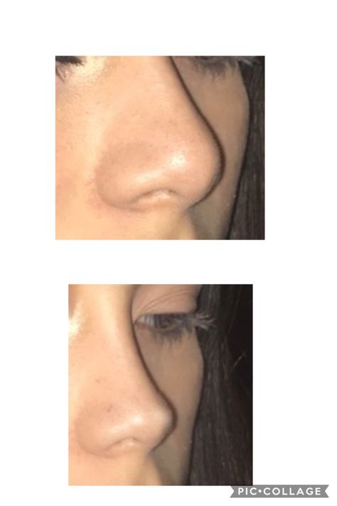 Ideal Facial Features, Nose Job Tape Aesthetic, Natural Looking Nose Job, Rib Removal Surgery Before And After, Upturn Nose, Subtle Nose Job, Nose Job Front View, Perfect Nose Front View, Nose Job Inspiration