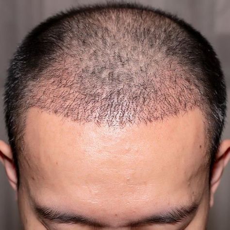 fue hair transplant Hair Stripping, Hair Implants, Hair Transplant Cost, Hair Transplant Procedure, Fue Hair Transplant, Best Hairstyles For Men, Hair Transplant Surgery, Best Hair Transplant, Best Hair Care