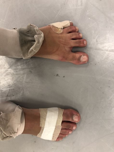 Ballet Dancers Feet Damage, Ballet Feet Damage Pointe Shoes, Ballet Feet Damage, Aesthetic Ballet, Physical Theatre, Ballet Aesthetic, Body Study, Art Foundation, Ballet Inspiration