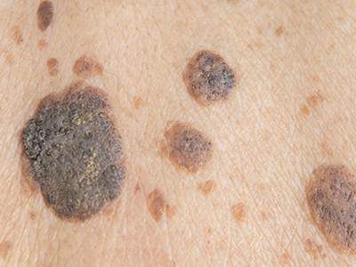 Watch for These Advanced Melanoma Warning Signs | HealthCentral Seborrheic Keratosis, Remove Skin Tags Naturally, Brown Spots On Skin, Skin Moles, Skin Growths, Mole Removal, Scaly Skin, Skin Tags, Skin Spots