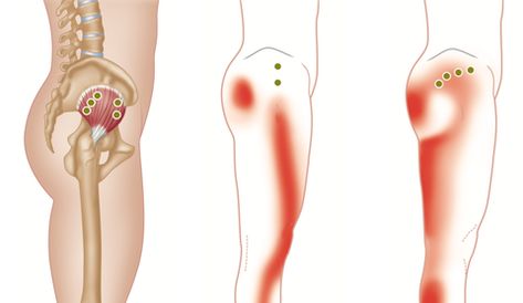 Trigger Points and Sciatic Type Pain - Gluteus Minimus – Nielasher.com Gluteus Minimus, Thoracic Outlet, Greater Trochanter, Bursitis Hip, Referred Pain, Fitness Board, Gluteal Muscles, Leg Cast, Hip Surgery