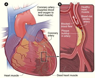 myocardial infarction | myocardial infarction Penyakit Jantung, Travel Post, Clogged Arteries, Cholesterol Remedies, Heart Muscle, Coronary Arteries, Ayat Al-quran, Nursing Notes, High Cholesterol