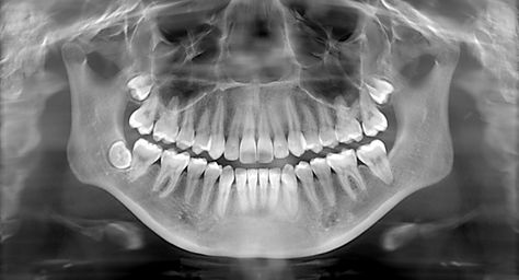 #XRays #Dental #Teeth Tooth Xray, Teeth Xray, Dental Xrays, Shadow Casting, Dental Posts, Living Fossil, Night Biking, X Rays, Maternal Health