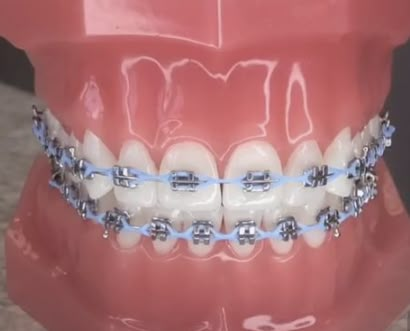 Dental Braces Colors, Braces Colors Combinations, Braces And Glasses, Braces Food, Cute Braces Colors, Pretty Teeth, Braces Tips, Getting Braces, Cute Braces