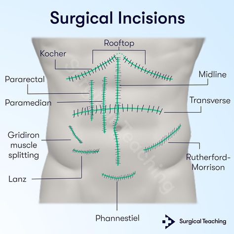 4,539 Likes, 18 Comments - Surgical Teaching (@surgicalteaching) on Instagram: “Do you know the different types of Surgical Incisions?⁠ ⁠ Want to learn more essential information…” Surgical Suture Chart, Surgical Terms, Surgical Oncology, Surgical Terms Medical Terminology, Surgical Incisions, Surgical Instruments Names, Physical Therapy Student, Medical Assistant Student, Medicine Studies