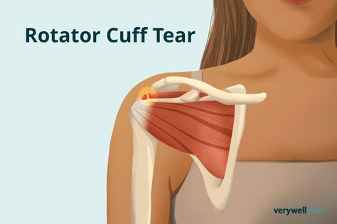 Rotator Cuff Tear: Warning Signs and the Healing Process Torn Rotator Cuff Symptoms, Torn Rotator Cuff, Rotator Cuff Tear, The Healing Process, Rotator Cuff, Healing Process, Warning Signs, Chronic Illness, Fun Workouts