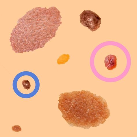 How to tell if your mole could turn cancerous- CosmopolitanUK Mole Placement Meaning, White Mole, Cancerous Moles, Burmese Kittens, Renal Cell Carcinoma, Abnormal Cells, Skin Moles, Mole Removal, Skin Growths