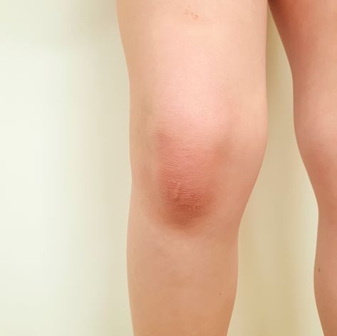 It's the largest joint in the body — and one of the most problem-prone. Swollen Knee, Below The Knee Dresses, Knee Wraps, Swollen Legs, Body Joints, Knee Exercises, Uric Acid, Sleep Health, Chronic Condition