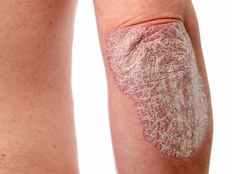 Psoriasis: Everything You Need to Know About This Chronic Skin Condition Cream Pictures, Face Cream Best, Whitening Cream, Skin Conditions, Doterra, Organic Skin Care, Cream, Health, Skin