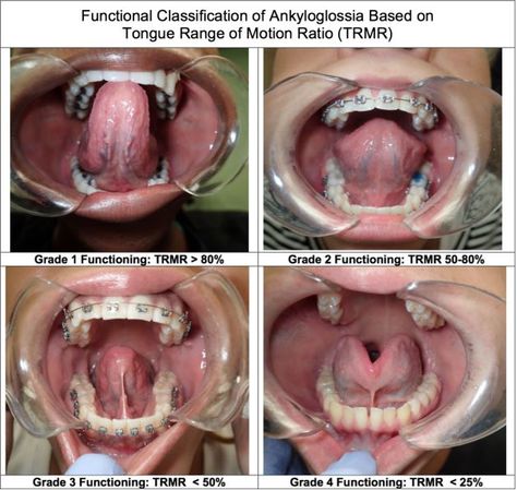 Do Tongue-Ties Affect Adults? What Symptoms Do They Have? - Alabama Tongue-Tie Center | Dr. Richard Baxter | Birmingham, AL Surgeon Humor, Nasal Obstruction, Oral Health Education, Home Remedies For Snoring, Speech Delay, Oral Surgeon, Tongue Health, Tongue Tie, Tooth Extraction