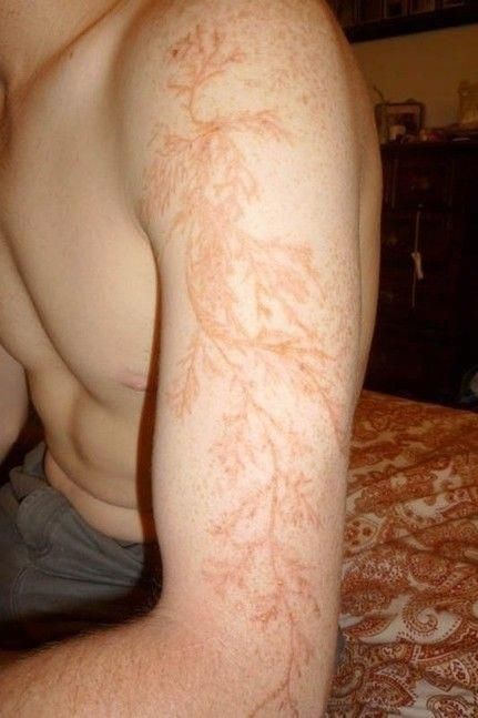 #ColdMedicineHomeRemedies Lightning Scar, Lightning Bolt Tattoo, Lichtenberg Figures, Lightning Tattoo, Bolt Tattoo, Home Remedy For Cough, Photographie Portrait Inspiration, Fractal Patterns, Cold Home Remedies