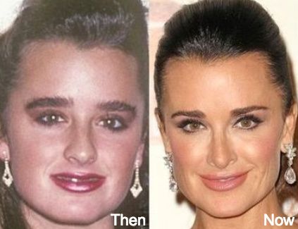 Kyle Richards Plastic Surgery Before and After Photos~ A nose job, her face/cheeks contoured, and the lips are improved too. Kyle Richards Plastic Surgery, Before And After Nose Job, Nose Plastic Surgery, Aniston Jennifer, Celebrity Surgery, Plastic Surgery Photos, Rhinoplasty Before And After, Rhinoplasty Surgery, Nose Surgery