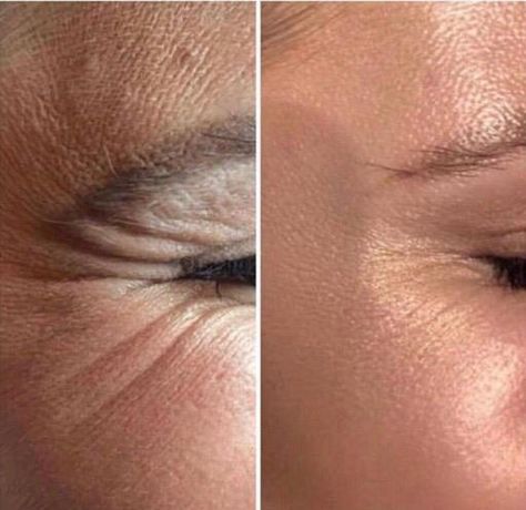 Crows Feet Botox Before After, Botox Before After, Skin Branding, Lipotropic Injections, Cosmetic Injections, Facial Injections, Crows Feet Wrinkles, Skin Highlighter, Botox Before And After