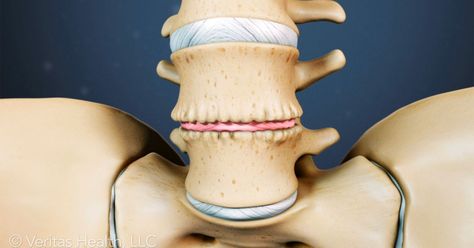 Degenerative Disk In Lower Back, Ruptured Lumbar Disc, Degenerative Lumbar Disc Disease, Cervical Disc Degeneration, Spinal Degeneration, Lumbar Disc, Intervertebral Disc, Bulging Disc, Spinal Fusion