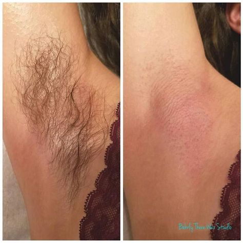 Before and after underarm wax! I recommend starting this in the winter months when we wear long sleeves so that we can hide our hair growth! It'll be thinned out come short sleeve weather. #dayton #ohio #brazilianwaxing #waxspecialist #waxing #esthetician #mensbrazilianwaxing #eyebrowwaxing #waxpro #beforeandafter #underarmwax Waxing Before And After, Waxing Esthetician, Natural Eyebrows Growth, Underarm Waxing, Wax Studio, Ingrown Hair Removal, Waxing Salon, Peeling Mask, Shaving Tips