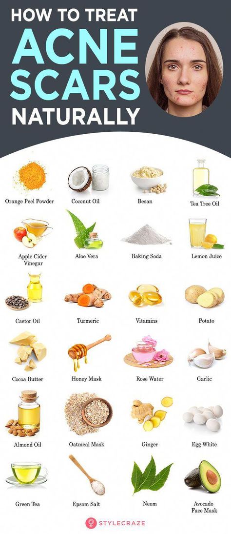 Natural remedies are an effective alternative to surgery or harsh techniques for treating acne scars. These 12 remedies can help lighten your scars gently. Remedies For Back Acne, Natural Cold Sore Remedy, Natural Remedies For Acne, Baking Soda Lemon Juice, Oatmeal Mask, Back Acne Remedies, Remedies For Acne, Sensitive Acne Prone Skin, Back Acne