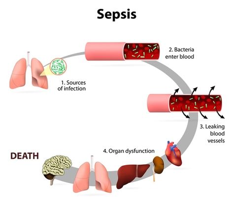 Sepsis is an extreme immune reaction of the human body toward serious bacterial infection circulating in the bloodstream. It becomes life-threatening or lethal when it manifests in the extreme stages of severe sepsis and septic shock. Blood Infection, Septic Shock, Nursing Care Plan, Nursing School Notes, Nursing Study, Bacterial Infection, Nursing Care, Care Plans, Blood Vessels