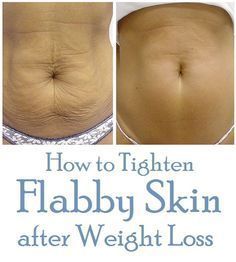 Sagging Belly, Flabby Stomach, Tighten Stomach, Flabby Belly, Skin Tightening Stomach, Loose Belly, Skin Tightening Cream, Tighten Loose Skin, Sleeve Surgery