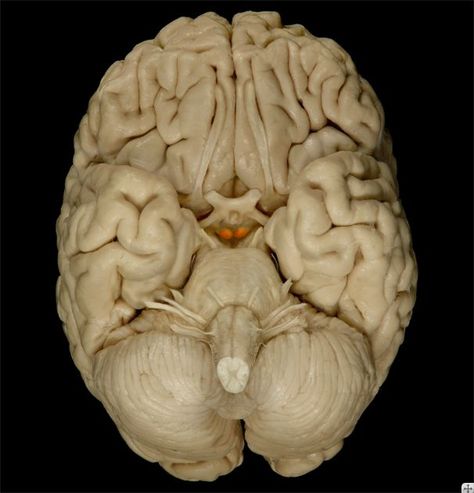 Mammillary bodies: implicated in memory and anterograde amnesia. Receives projections from the hypothalamus via the fornix (splits at anterior commissure), projects to the anterior nucleus of the thalamus via the mammillothalamic tract. Anterograde Amnesia, Anatomy Diagrams, Brain Mapping, Nerve Fiber, Anatomy Physiology, Cardiac Nursing, Cranial Nerves, Brain Art, The Human Brain