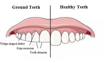 Wedge-shaped defect is a non-carious lesion of enamel, which is localized at the necks of the teeth. There are two common reasons for this lesion: improper brushing technique and tooth grinding or abrasion. Family Dental Care, Gum Recession, Dental Fillings, Teeth Grinding, Dental Facts, Family Dentist, Teeth Health, Best Teeth Whitening, Grinding Teeth