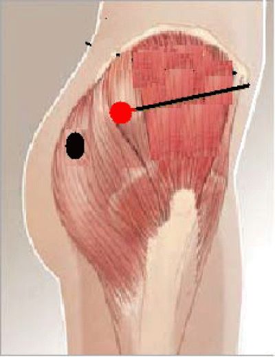 The red circular area represents the ventrogluteal injection site, while the black one represents the dorsogluteal injection point. The black line indicates the distance of the ventrogluteal site to the anterior superior Ventrogluteal Injection, Injection Sites, Nursing 101, Physical Rehabilitation, Trigger Point, Nursing Programs, Trigger Points, Medical Education, Black Line