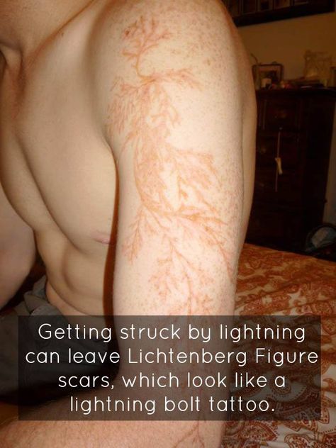 Lichtenberg Figures are fractal patterns from electric discharges and can be found on a variety of materials Lightning Scar, Lightning Bolt Tattoo, Lichtenberg Figures, Lightning Tattoo, Bolt Tattoo, Struck By Lightning, Home Remedy For Cough, Photographie Portrait Inspiration, Fractal Patterns