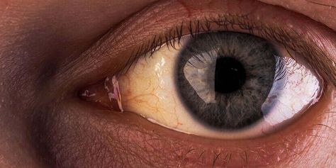 Eyes with a yellow tinge to the sclera, or white area Gilbert's Syndrome, Bilirubin Levels, Gastric Problem, Alcohol Use Disorder, Parts Of The Eye, Bile Duct, Below The Knee Dresses, Small Nurseries, Genetic Disorders