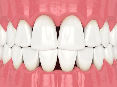 Black triangles on your teeth are small teeth gaps that can harbor food and bacteria Gum Graft, Cosmetic Bonding, Teeth Bonding, Fix Teeth, Misaligned Teeth, Dental Bonding, Teeth Shape, Gap Teeth, Periodontal Disease