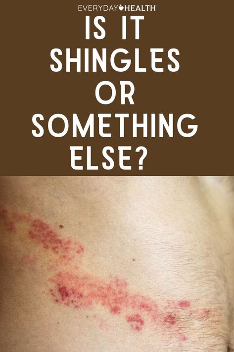 Learn the difference between the shingles rash and other common skin problems such as hives or psoriasis. Gluten Rash Pictures, Skin Rashes Pictures Types Of, Shingles Symptoms Signs, Hives On Face, Itchy Skin Causes, Rash On Buttocks, Shingles On Face, Rash On Stomach, Skin Conditions Pictures