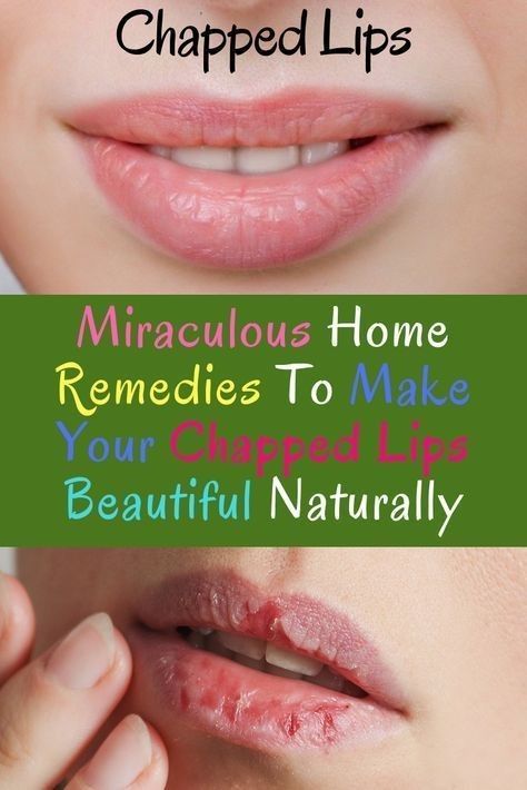 Dry Lips Remedy, Chapped Lips Remedy, Dark Patches On Skin, Hydrogen Peroxide Teeth Whitening, Lighten Dark Lips, Peroxide Teeth Whitening, Dry Cracked Lips, Healthy Book, Face Glow