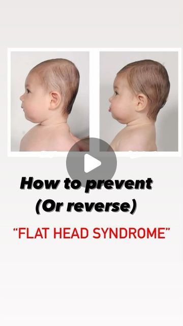 Dr. Mommy on Instagram: "Applying these tips consistently you can help prevent or improve flat head but remember it’s always better to consult with your doctor if you are worried about your baby’s flat head.

#pregnancyjourney #ninemonths 
#newbornlove #breastfeedingjourney #momlife #dadlife #parentingtips #babybonding #familymoment #firsttimeparents #newparentadventures #babysnuggles #parentinghacks #babymilestones #breastfeedingmama #parenthood #newborncare #mom #dad #boy #girl #baby #babyboy #babygirl #bumpprogression #pregnancymilestones 
#maternity #expecting #babyontheway 
#momtobe" Different Head Shapes, Bump Progression, Baby Head Shape, Flat Head Baby, Flat Head Syndrome, Pregnancy Milestones, 3 Month Old Baby, First Time Parents, Pregnancy Journey