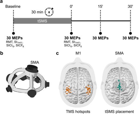 Transcranial static magnetic field stimulation of the supplementary motor area decreases corticospinal excitability in the motor cortex | @Nature @TheBrainDriver #tDCS #BrainStimulation #Alzheimer’s #Dementia #Parkinson’s https://www.nature.com/articles/s41598-024-57030-0 Pilot Study, Null Hypothesis, Transcranial Magnetic Stimulation, Brain Diseases, Brain Stimulation, Statistical Analysis, Magnetic Field, Brain, Magnets