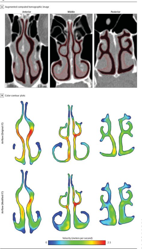 Figure 1 from Computational Fluid Dynamics to Evaluate the Effectiveness of Inferior Turbinate Reduction Techniques to Improve Nasal Airflow | Semantic Scholar Sinus Medicine, Cfd Simulation, Paranasal Sinuses, Nasal Obstruction, Parts Of The Nose, Computational Fluid Dynamics, Nasal Septum, Neck Surgery, Regression Analysis