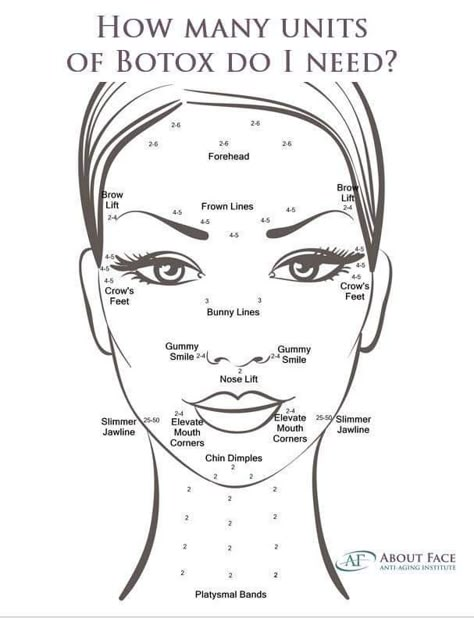 Botox Forehead, Botox Injection Sites, Facial Injections, Botox Facial, Injection Sites, Botox Injection, Botox And Filler, Aesthetic Nursing, Botox And Fillers