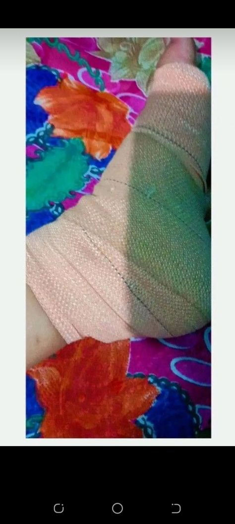 Fake Injury Leg Snapchat, Leg Bandage Snap, Leg Fracture Snapchat Story, Fake Bandage Snap, Accident Snap Ideas, Injury In Leg, Leg Injury Snapchat Streaks, Fracture Hand Snapchat, Leg Accident Real Pic