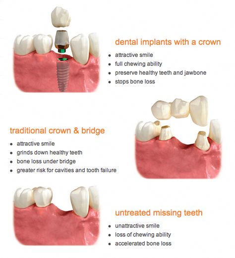 All On Four Dental Implants, Dental Infographics, Dental Content, Design Clinic, Tooth Implant, Clinic Art, Dental Wallpaper, Dental Assistant Study, Dental Advertising