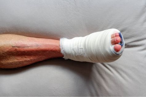 Many wonder how to reduce swelling after bunion surgery because it is very common. Learn how to deal with this issue and improve your recovery process. Bunionectomy Recovery, Plantar Plate Tear, Ankle Pumps, Ankle Surgery, Happy Mommy, Reduce Swelling, Surgery Recovery, Calf Muscles, Leg Muscles