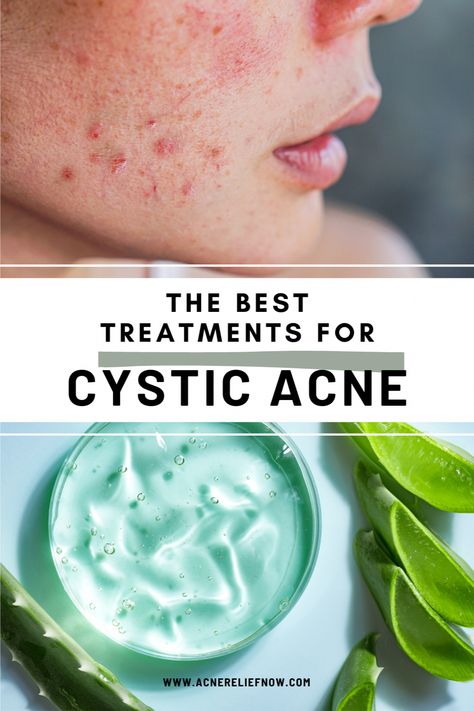 Understand what is cystic acne and treatments available in this comprehensive guide. Learn the best possible treatments. Acne Scab, Hormonal Cystic Acne, Get Rid Of Cystic Acne, Acne Diet Plan, Cheek Acne, Treating Cystic Acne, Cystic Acne Remedies, Acne Tips, Acne Diet