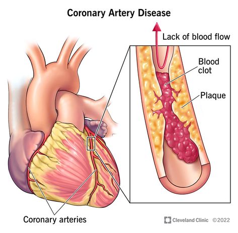 Your heart muscle needs blood, too, and it can’t get enough if you have narrow coronary arteries from plaque. Learn about coronary artery disease. Acute Coronary Syndrome, Coronary Artery, Chest Discomfort, Coronary Arteries, Heart Muscle, Heart Problems, Shortness Of Breath, Cardiovascular Disease, Blood Flow