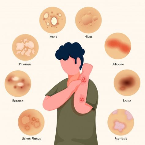 Faceless young boy itching his hands and... | Premium Vector #Freepik #vector #background #poster #hand #medical Heat Rash, Skin Rashes, Herbal Bath, Bacterial Infection, Natural Therapy, Natural Home Remedies, His Hands, Spreads, Home Remedies