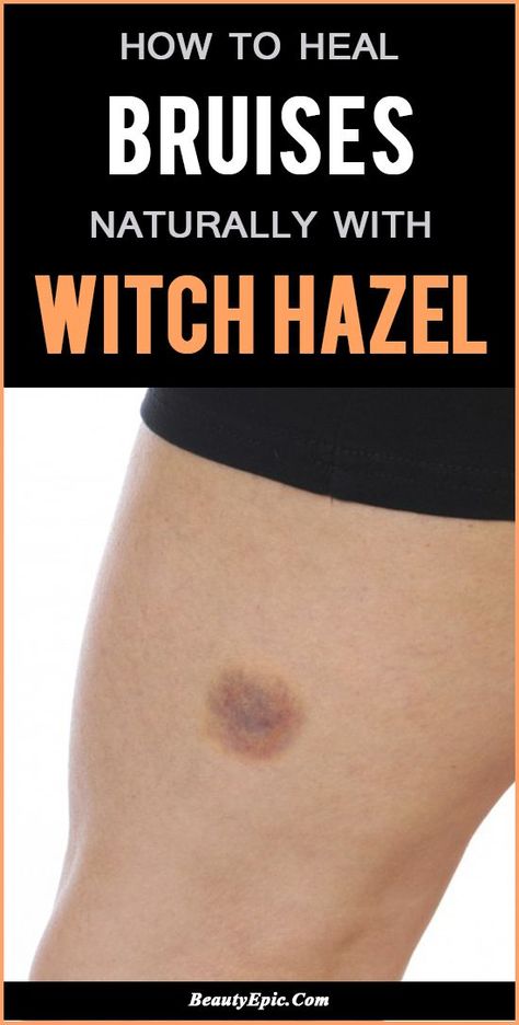 Bruising Remedies, Witch Hazel Acne, Witch Hazel Uses, Reduce Bruising, Witch Hazel For Skin, Beauty Diy Skincare, Tea Tree Oil For Acne, Witch Hazel Toner, Medical Binder