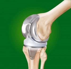 knee replacement Recovering From Knee Replacement Surgery, Full Knee Replacement, Hyperextended Knee, Knee Replacement Surgery Videos Total, Partial Knee Replacement, Knee Replacement Recovery, Knee Operation, Knee Replacement Exercises, Pain Management Techniques