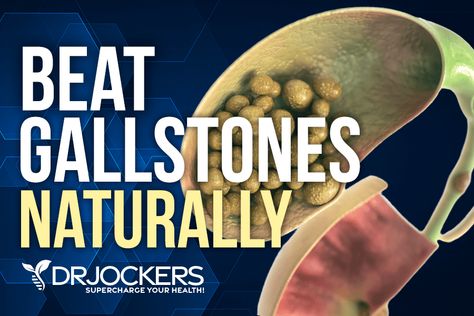 Gall Stones Symptoms Gallstone, Gallstone Diet Gallbladder Cleanse, Gallstone Symptoms, Gallstone Cleanse, Gallbladder Symptoms, Gallstone Diet, Gallbladder Health, Gallbladder Flush, Gallbladder Attack