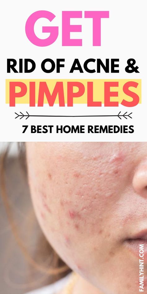 The ultimate guide to get rid of acne pimples fast at home | Clear skin tips | clear skin tips dark spots | clear skin tips for teenagers | clear skin tips pimples | clear skin tips overnight | clear skin tips for oily skin | clear skin tips skincare | foods for clear skin | clear skin products | how to get clear skin in a week | how to get clear skin fast naturally | skin care routine | skin care products | skincare How To Take Care Of My Face, How To Get Clear Skin Overnight At Home, How To Get Rid Of Pimples Overnight Fast Clear Skin, Natural Ways To Clear Acne, Acne Hacks Clear Skin, How To Clear Up Your Skin In A Week, Vitamins For Acne Clear Skin, How To Get Rid Of Acne In A Week, How To Get Clear Skin In A Week