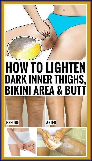 How To Lighten Dark Inner Thighs Naturally Dark Inner Thighs, Tiny Shorts, Health Tips For Women, Micro Mini Skirt, Inner Thigh, Micro Mini, Health Check, Health Facts, Mens Health