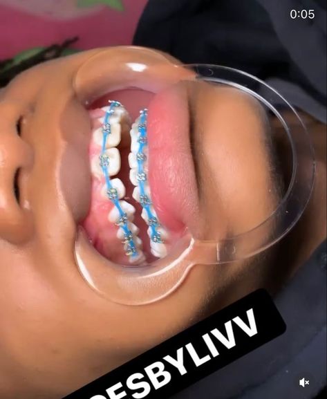 Bracers For Teeth Color, Teal Power Chain Braces, Powerchain Braces Aesthetic, Pink Power Chain Braces, Sky Blue Braces, Light Blue Braces, Braces Colors Ideas Cute, Power Chain Braces, Braces On Teeth